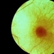 Choroidal atrophy, probable choroideremia Choroidal atrophy, probable choroideremia
